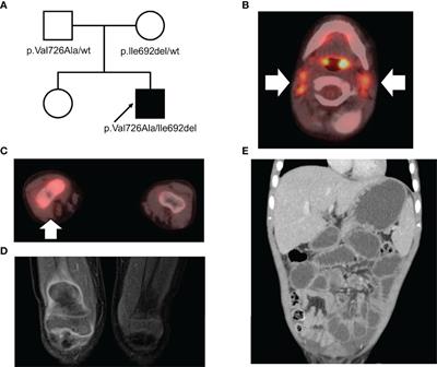 Case Report: A Pediatric Case of <mark class="highlighted">Familial Mediterranean Fever</mark> Concurrent With Autoimmune Hepatitis